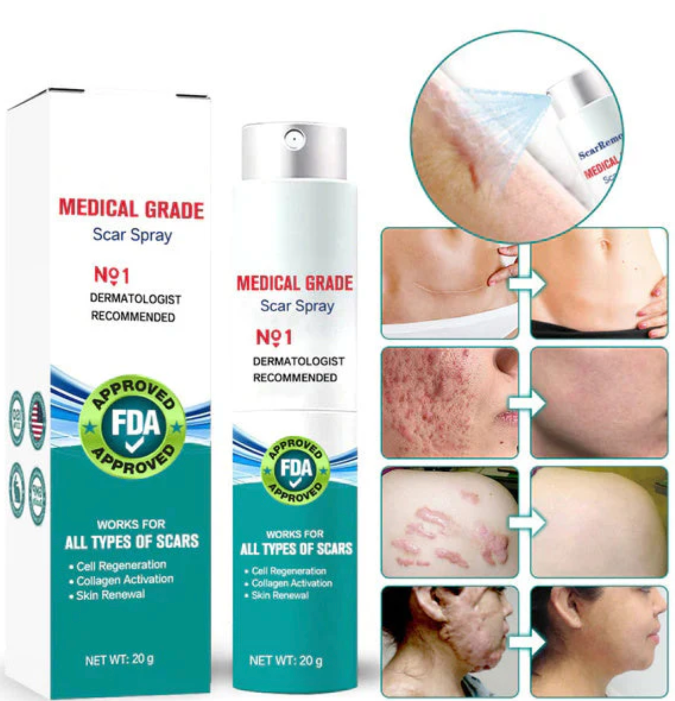 Cicacell™ – Tratamiento de mejora de cicatrices y estrías