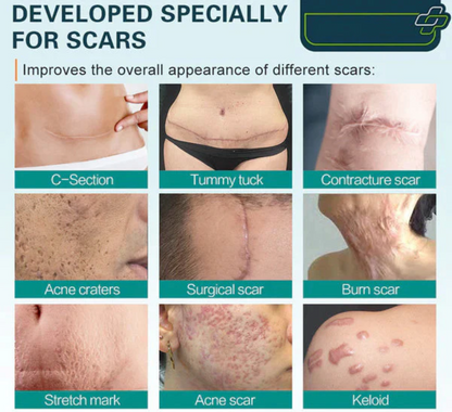 Cicacell™ – Tratamiento de mejora de cicatrices y estrías